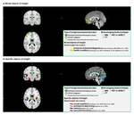 Neural correlates of altered insight in frontotemporal dementia, a systematic review